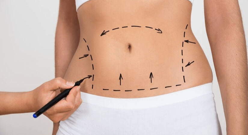 Smartlipo®: Your Questions, Answered