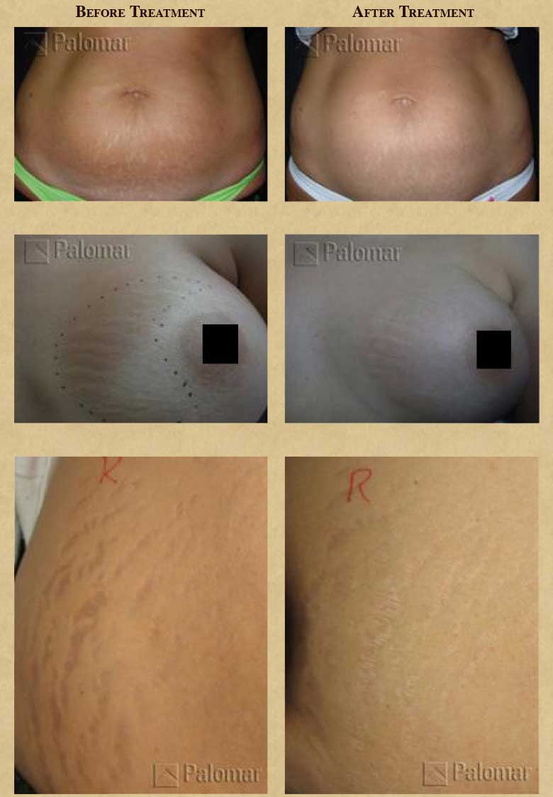 Before and after stretch mark removal Before and after stretch mark removal