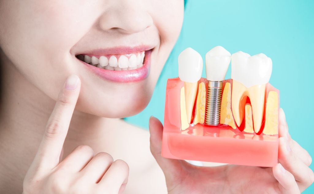 Do Dental Implants Look Like Real Teeth?