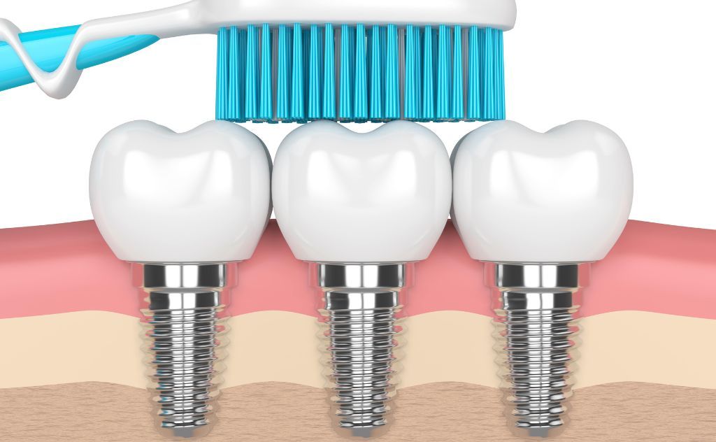 How Do I Clean Dental Implants