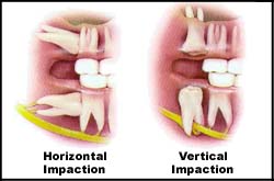Horizontal Impaction and Vertical Impaction