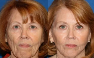 Before and after of fat grafting treatment