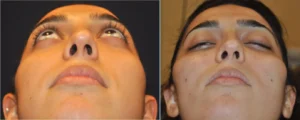 Before and after of fat grafting treatment