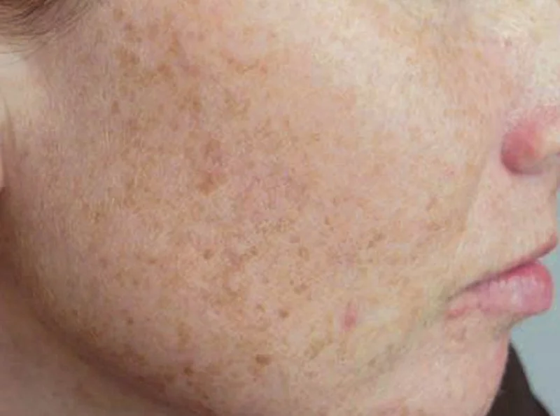 Before Pulsed Light Photofacial