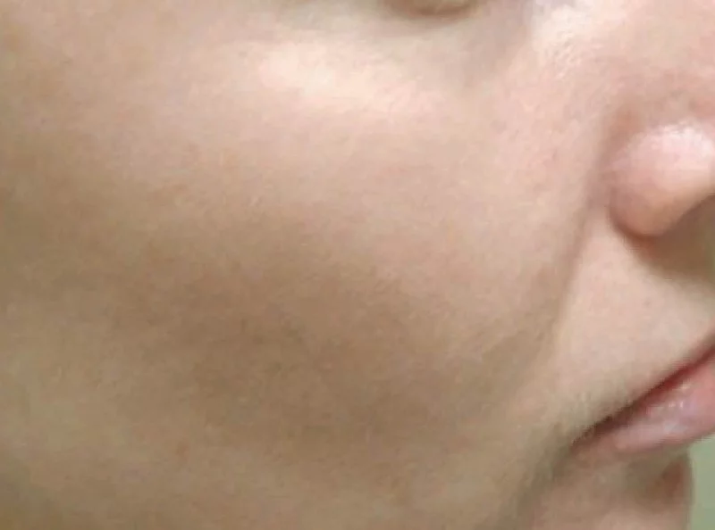 After Pulsed Light Photofacial