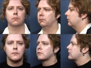 Before and after facial liposuction on a man from multiple angles at Virginia Surgical Arts in Virginia Beach, VA
