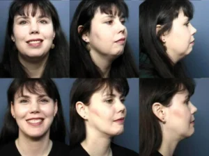 Before and after side profile and front view of woman showing facial transformation results at Virginia Surgical Arts in Virginia Beach, VA.