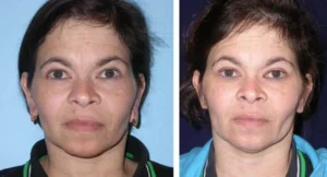 Before and after image of a woman showing facial changes and improvements.
