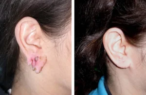 Female patient's right ear before and after otoplasty procedure at Virginia Surgical Arts in Virginia Beach, VA.