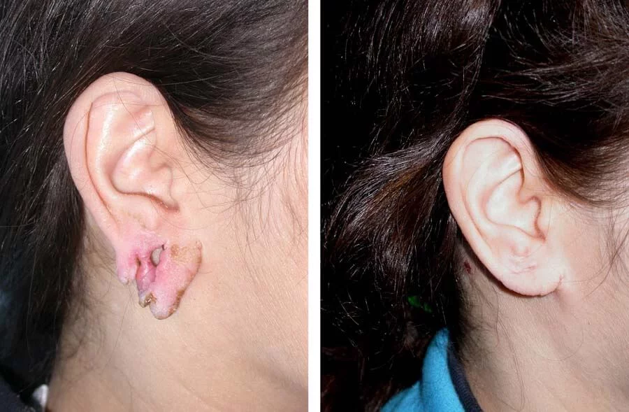 Before and after image of otoplasty procedure Before and after image of otoplasty procedure