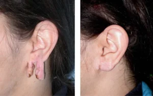 Before and after keloid removal surgery on earlobes, showing significant reduction in growth and scarring.