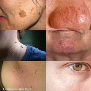 Collage displaying various skin conditions: moles, skin tags, nose veins, and under-eye texture. Collage displaying various skin conditions: moles, skin tags, nose veins, and under-eye texture.