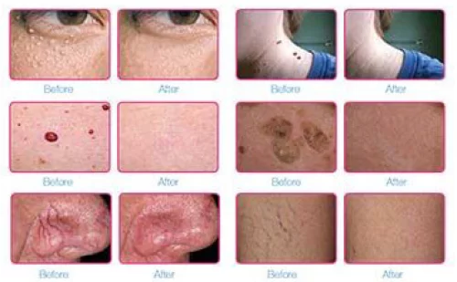 Before and after skin treatment results showing reduced wrinkles, moles, and blemishes on the face, neck, and chin. Before and after skin treatment results showing reduced wrinkles, moles, and blemishes on the face, neck, and chin.