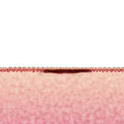 IPL Photo Therapy Animation