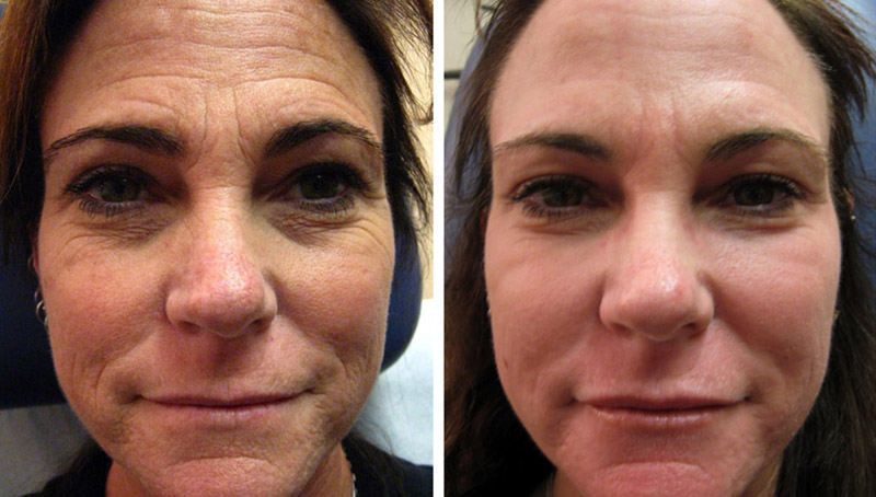 CO2RE Micro Fractional Laser Treatment