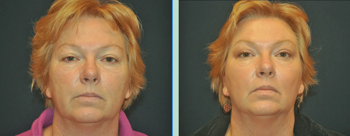 Laser Skin Resurfacing before and after