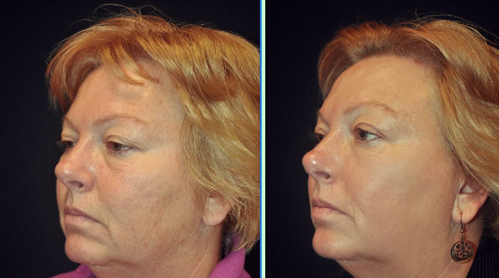 before and after Skin Resurfacing