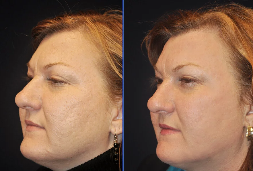 laser skin resurfacing treatment