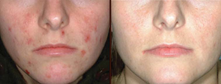Before and after IPL Rosacea and Acne Treatment Before and after IPL Rosacea and Acne Treatment