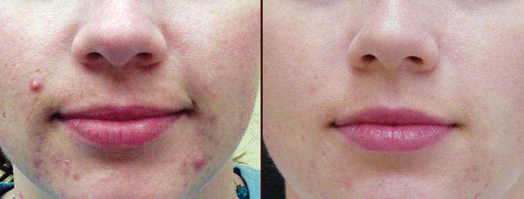 Before and after IPL Rosacea and Acne Treatment Before and after IPL Rosacea and Acne Treatment