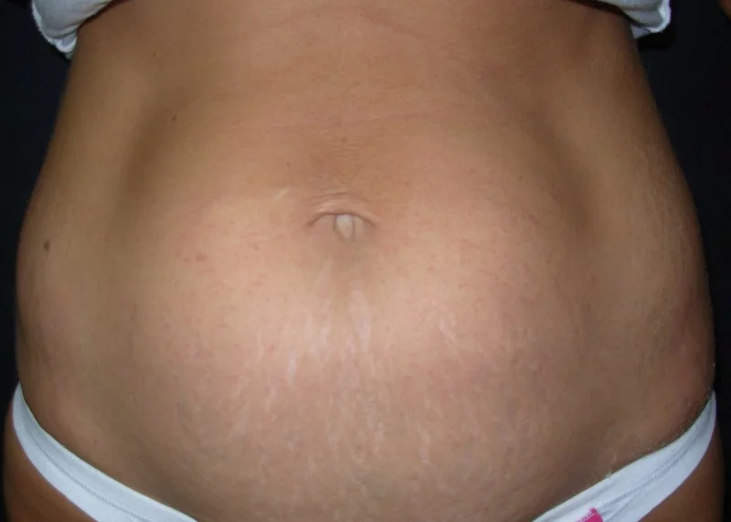 A mans back with a litte to no hair after the Laser Hair Removal technique.