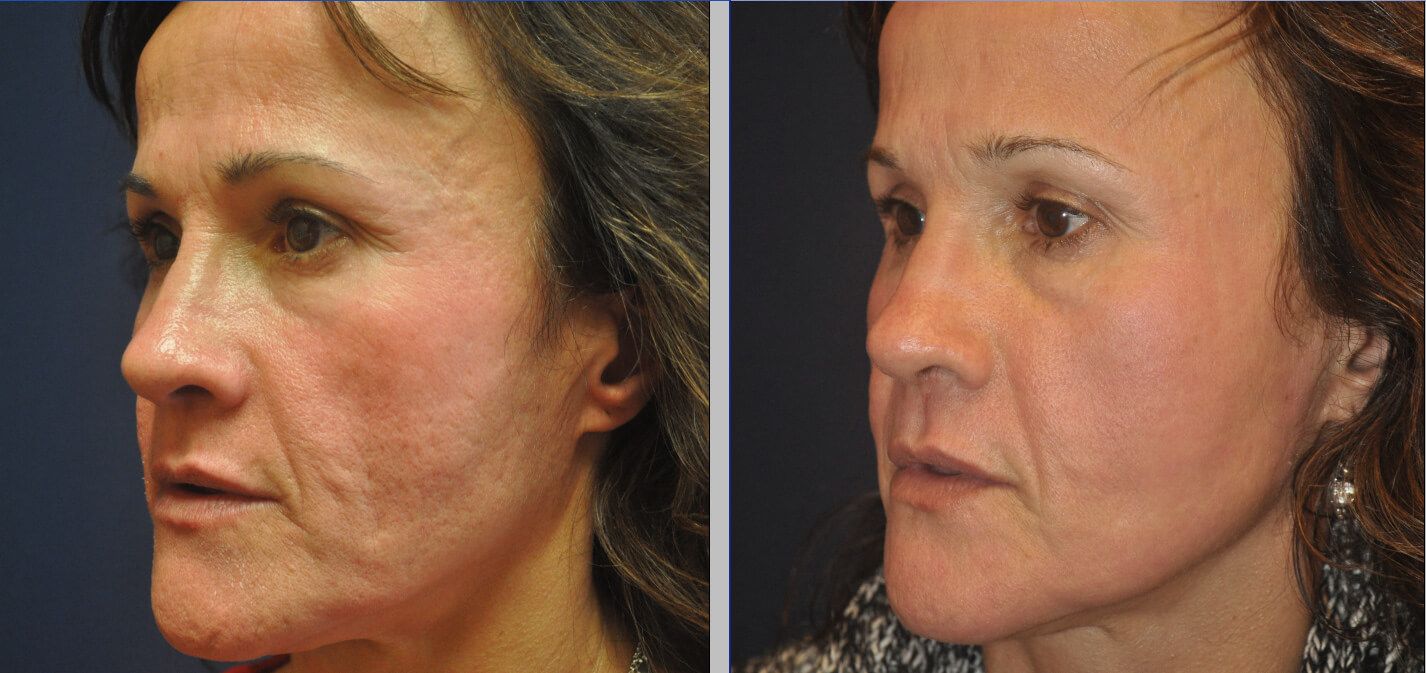 Before and after acne scar treatment on a woman's face, showing improved skin texture and tone.