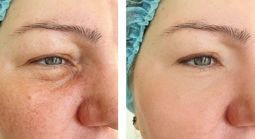 Before and After IPL Rosacea and Acne Treatment Before and After IPL Rosacea and Acne Treatment