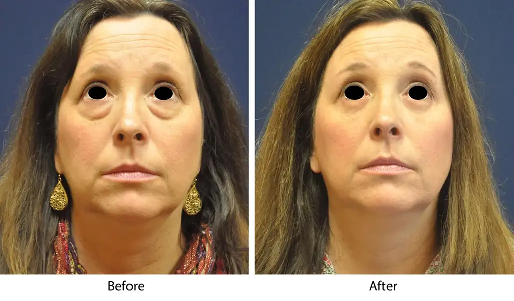Before and after facial transformation, showcasing significant improvements.