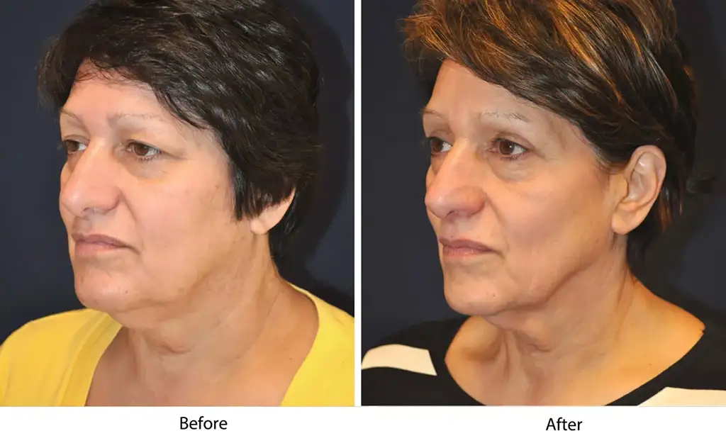 Before and after images showing facial transformation results.
