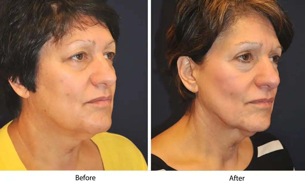 Before and after images show noticeable facial changes post-cosmetic procedure, highlighting improved appearance.