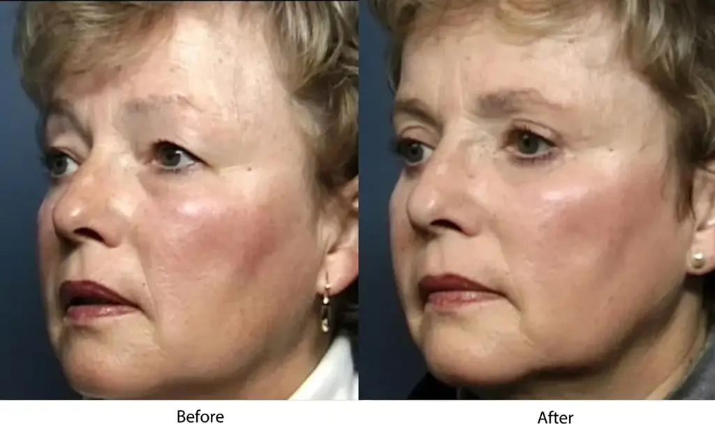 Side-by-side comparison of a woman's face before and after a cosmetic procedure, showing improved skin texture.