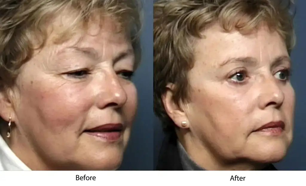 Before and after image showing facial rejuvenation results in an older woman.