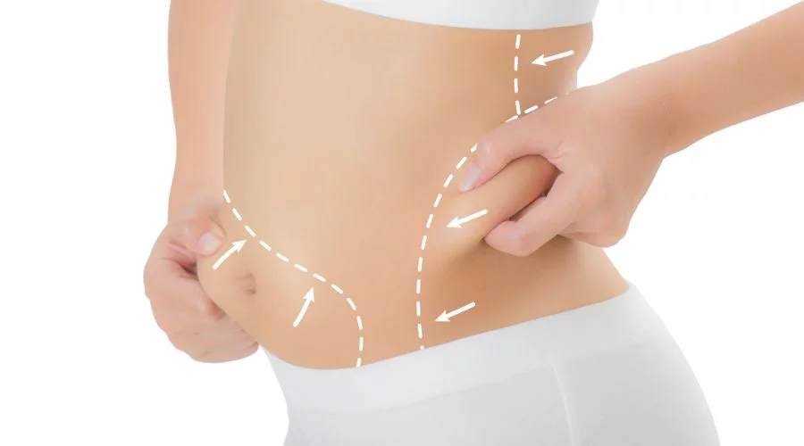 How Do I Reduce Swelling After Liposuction Surgery?