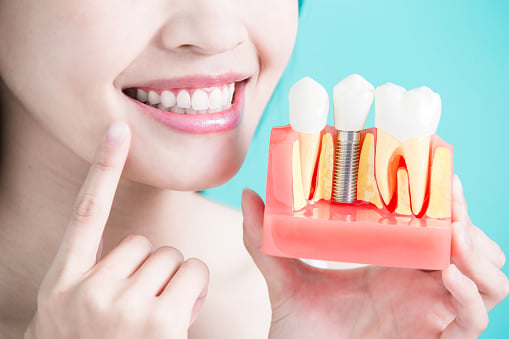 Close up of woman pointing to teeth and holding a dental implant model at Virginia Surgical Arts in Virginia Beach, VA
