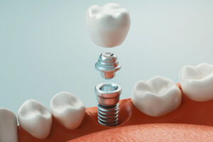 Diagram of single tooth implant being placed in between two healthy teeth illustrated by Virginia Surgical Arts in Virginia Beach, VA